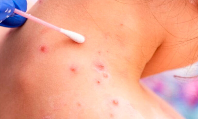 Confirman segunda muerte por viruela sísmica en Argentina: el paciente era de riesgo